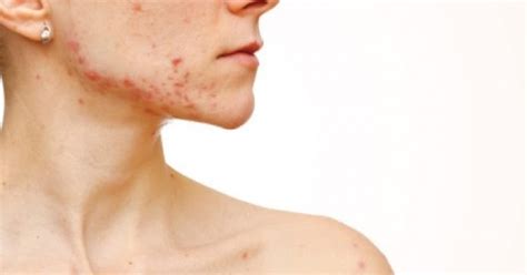 Chest Acne What Causes It And 12 Ways To Get Rid Of Chest Acne Fast