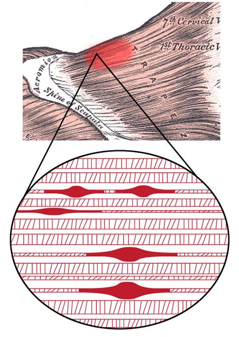 Myofascial Pain Syndrome Wikimsk