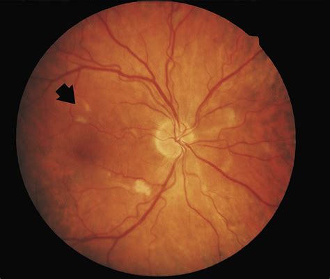 Combined Choroidal And Retinal Ischemia During Interferon Therapy