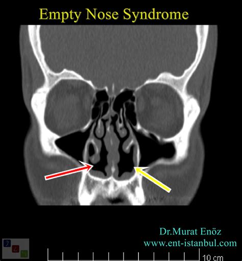 Cool Small Dry Turbinate Empty Nose Syndrome