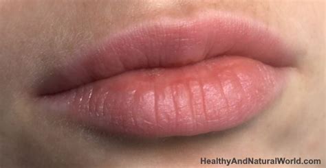 How To Get Rid Of Bumps On Lips Naturally Chapped Lips Remedy Cold
