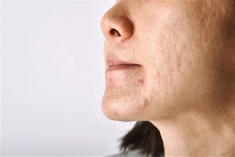 Acne Breakouts Common Causes And How To Prevent It