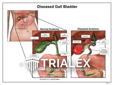 Symptoms Of Gallbladder Disease In Humans Males And Females My Xxx