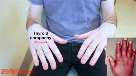 Thyroid Skin Rash