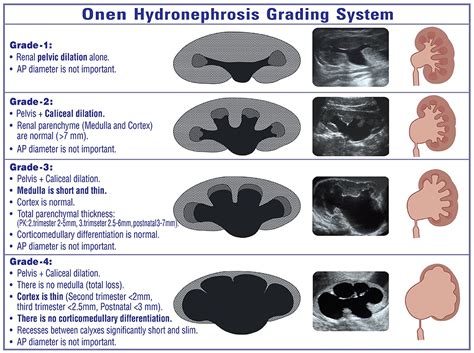 Hydronephrosis Grading Ultrasound