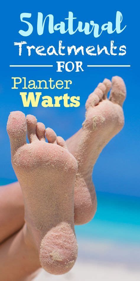How And Why To Treat Plantar Warts Naturally 5 Ways Warts Get Rid