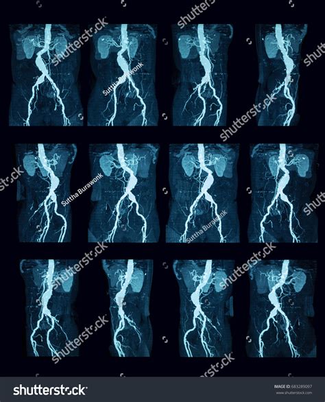 Computed Tomography Angiography Ct Angiography Cta Stock Photo