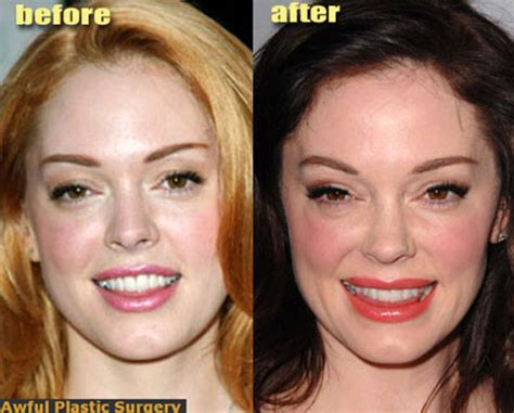 Celebrity Plastic Surgery Before And After 56 Pics Picture 48