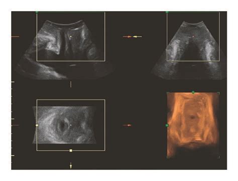 Lower Urinary Tract On Three Dimensional Transperineal Ultrasound