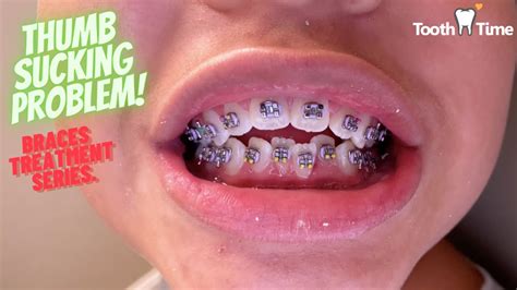 Braces On Thumb Sucking Problem Treatment Video Tooth Time
