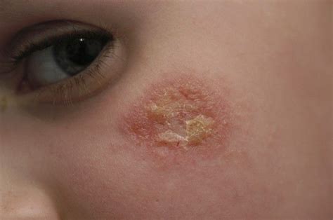 Sudden Itchy Rash On Face Eczemas Scaly Itchy Rashes