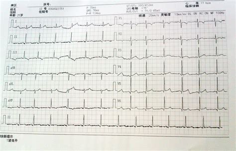 这是体检的心电图，提示T波低平，是正常的心电图么？谢谢_百度知道