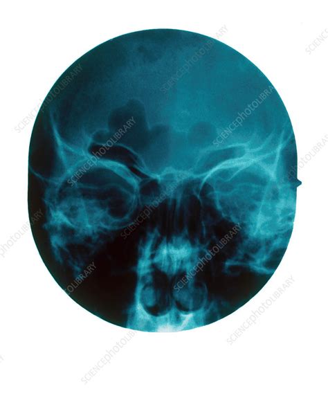 Nasal Polyps X Ray