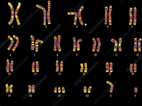 Down Syndrome Karyotype Trisomy 21 Embryology Down Syndrome May Be Suspected If A Newborn