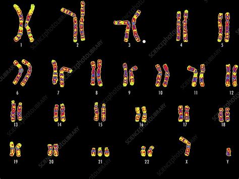 What are the karyotypes of down syndrome? Down's syndrome karyotype - Stock Image - C001/8360 - Science Photo Library