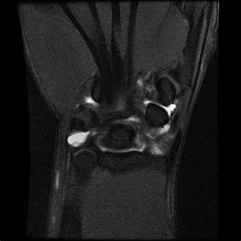 Normal Wrist 3t Mri Radiology Case