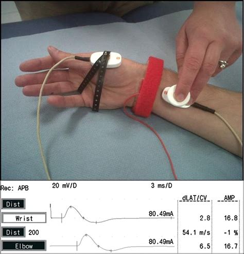 Snaps Cmaps And F Waves Nerve Conduction Studies For The Uninitiated
