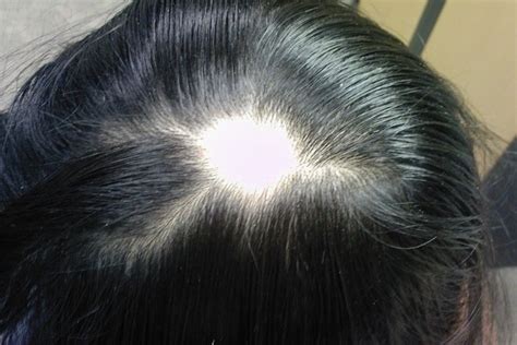 Alopecia Areata Symptoms Causes Treatment Tua Saúde