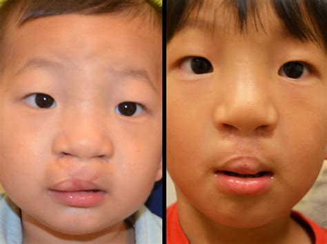 An alveolar bone graft is a surgery to fill a gap in the bone of the upper jaw. Cleft Lip Revision | The Cleft Palate and Craniofacial Ins ...