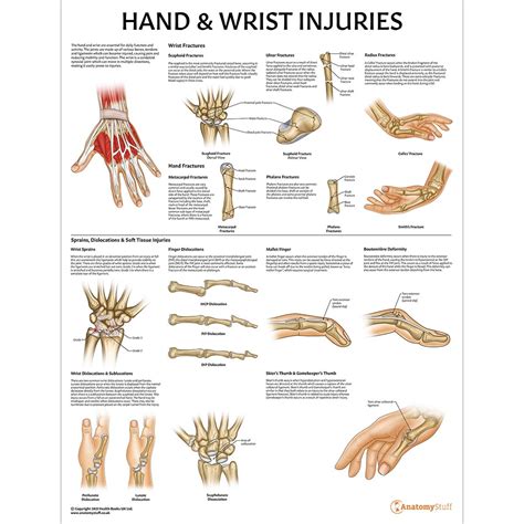 Hand And Wrist Injuries Poster Fractures Sprains Dislocation Chart
