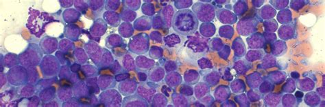 Malignant Transformation Of A Viral Papilloma In A Case Study Cytopath