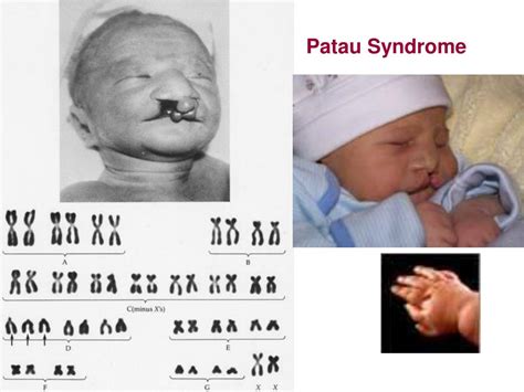 Ppt Chromosome Abnormalities Powerpoint Presentation Free Download Id5175561