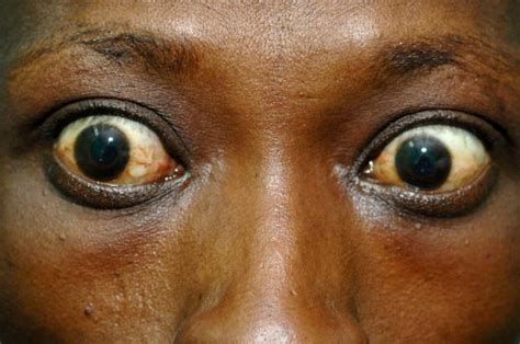 Exophthalmos Bulging Eyes Nidirect