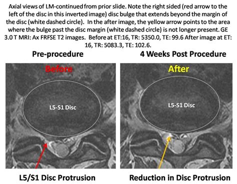 .lumbar magnetic resonance imaging (mri) for the automatic detection of abnormalities and we proposed a robust method to detect herniated lumbar disc. Stem cells repair disc without surgery