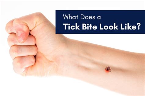 What Does A Tick Bite Look Like Proven Insect Repellent