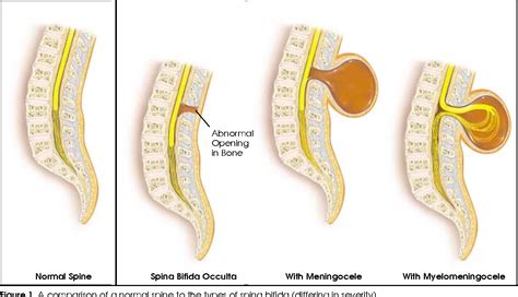 Figure 5 From Integrating The Spina Bifida Patient Into The General