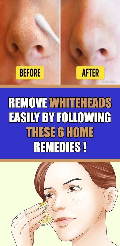 Remove Whiteheads Easily By Following These 6 Home Remedies 33