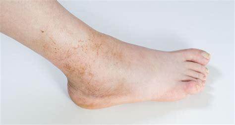 Swollen Ankle Injuries With Symptom Ankle Swelling
