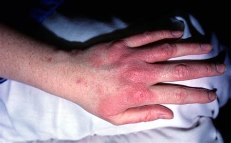 Vesicular Hand Dermatitis Treatment