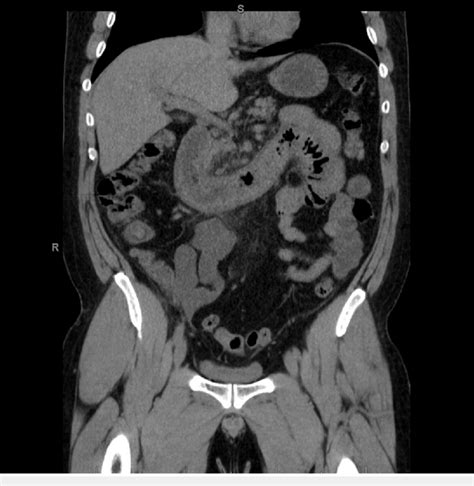 Coronal Section Of Ct Abdomen And Pelvis With Contrast Showing Bowel