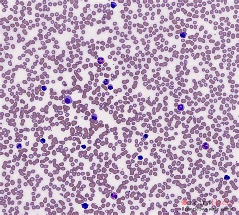 Plasma Cell Leukaemia Learnhaem Haematology Made Simple