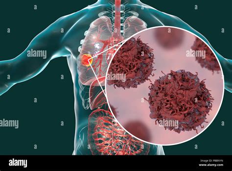 Lung Cancer Computer Illustration Showing A Cancerous Tumour In The