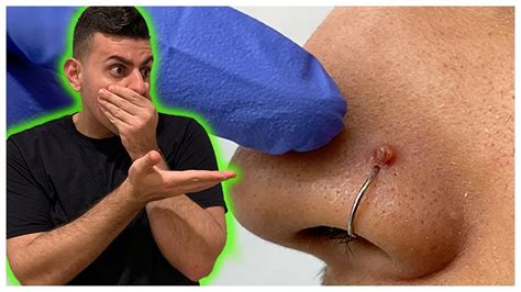 It may be that when you squeezed the pus out of it, you irritated it. Nose Piercing With A Hoop Gets A Huge Bump!! **Removal ...