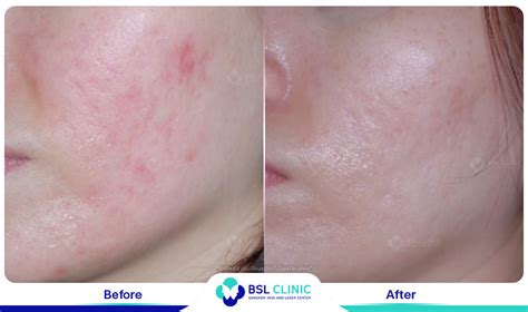 Rosacea Red Birthmark Facial Redness Bangkok Aesthetic Clinic