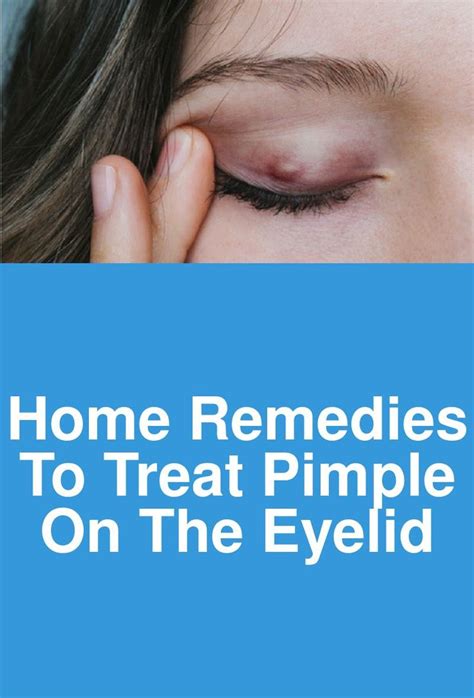 Home Remedies To Treat Pimple On The Eyelid With Images Pimples