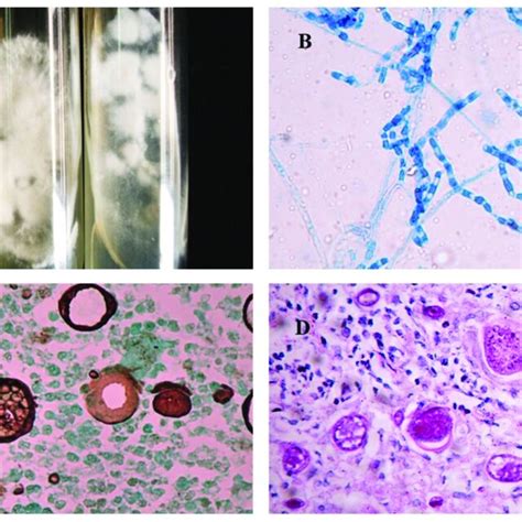 Natural History Of Paracoccidioidomycosis With A Focus On Pathogenesis