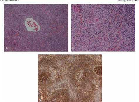 Figure 1 From Thymic Marginal Zone B Cell Lymphoma Of Mucosa Associated