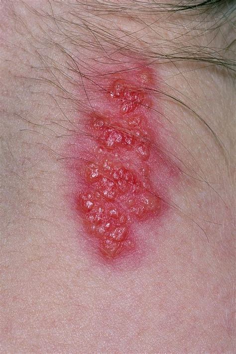 Close Up Of Shingles Rash On Back Of Womans Neck Photograph By Dr P Marazziscience Photo Library