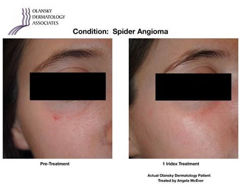 In most cases only one treatment is necessary. Atlanta Cherry Angioma Before & After Photos