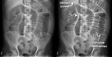 Abdominal X Ray Abnormalities Small Bowel Obstruction
