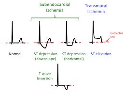 Pain in chest usually happen without a predictable pattern, while resting, early in the morning, but also can be caused because of emotional stress. prinzmetal angina - Google Search | Cardiovascular system ...