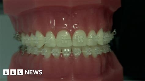 Adult Braces More People Paying Thousands For Straighter Teeth Bbc News