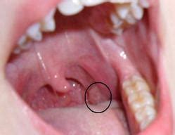 An oral tumor is an abnormal growth and unregulated replication of cells that occur within the mouth. Mouth And Throat Cancer Treatment Service in Anand, Anand ...