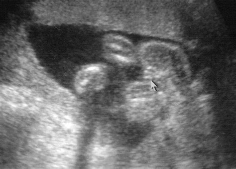 What Does A Baby Girl Look Like On Ultrasound