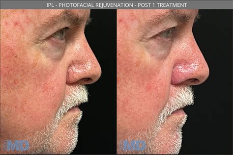 Ipl Photofacial Boston Skin Md Laser And Cosmetic Group