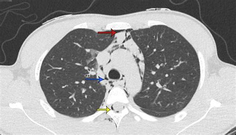 Transverse View Of Computed Tomography Of Thorax Showing Presence Of